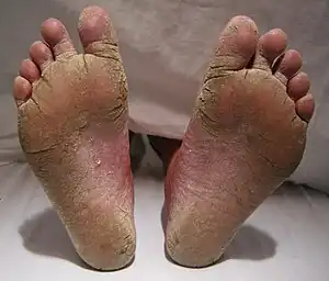 Tinea of feet