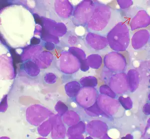 Acute myeloid leukemia, showing characteristic growth of abnormal white blood cells