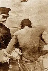 Soldier with severe mustard gas burns to back and arms, circa 1918. These burns are severe enough to be life-threatening.