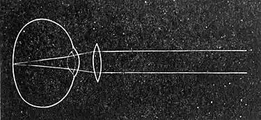 EB1911 Vision - Hyperopic Eye and Convex Lens.jpg